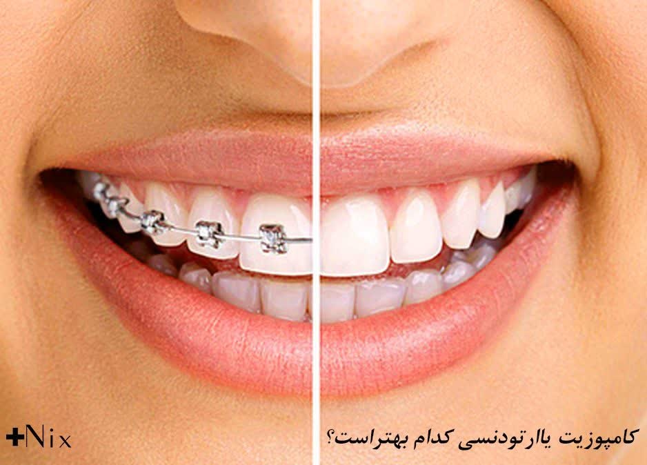 مقایسه جامع کامپوزیت دندان با لمینت، ارتودنسی و بلیچینگ