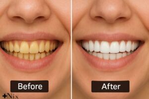 مراقبت از لمینت دندان