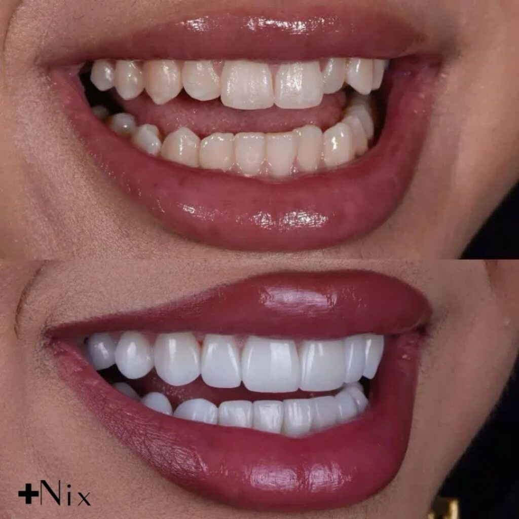 لمینت دندان