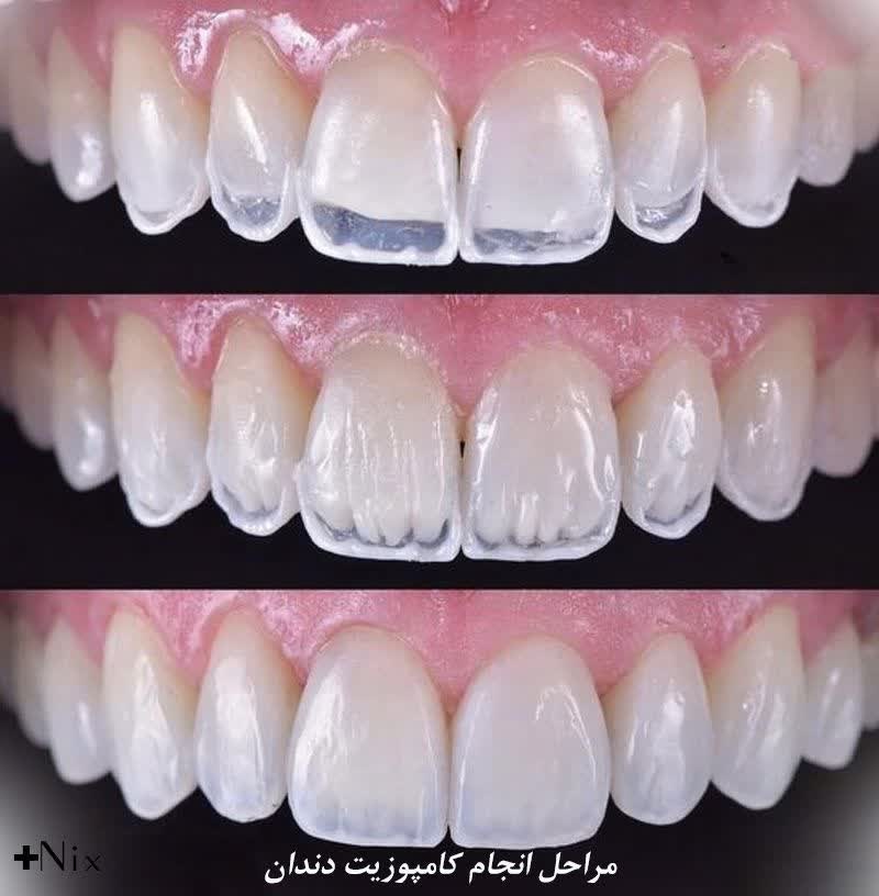 روش انجام کامپوزیت