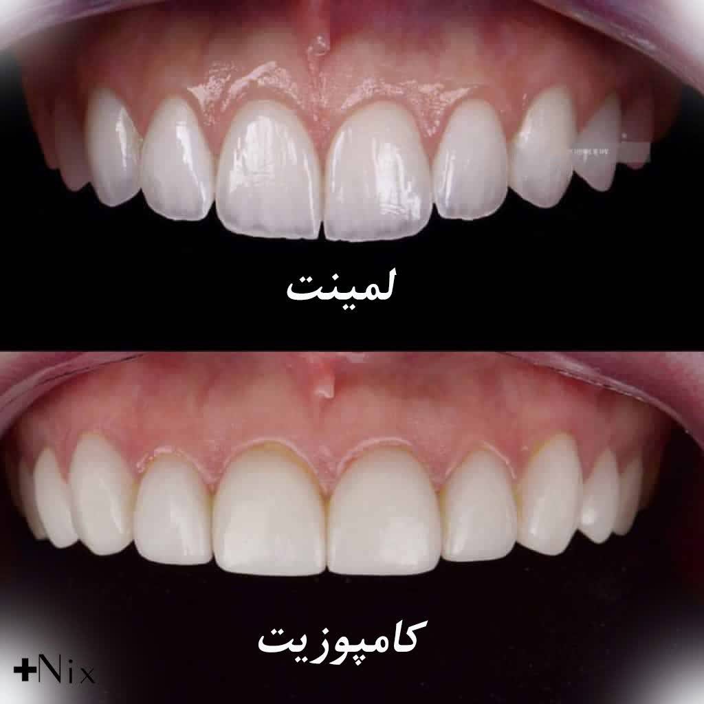 کامپوزیت یا لمینت