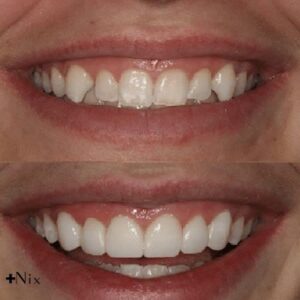 مقایسه کامپوزیت میکروفیل و هیبرید