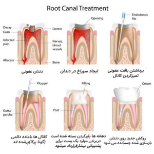 درمان ریشه دندان