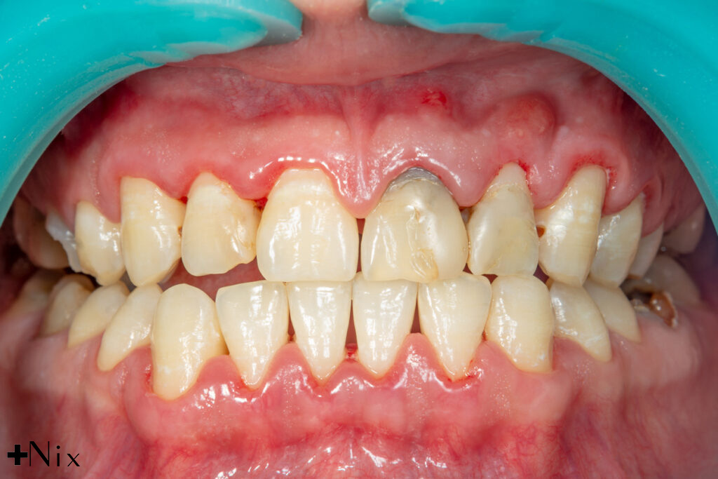 درمان بیماری لثه