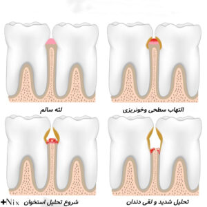 درمان بیماری لثه