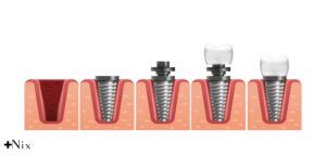 معایب ایمپلنت دندان