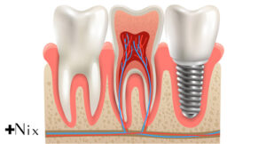 مزایای ایمپلنت دندان