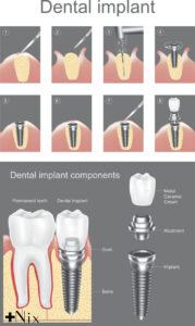 پروتز نهایی ایمپلنت