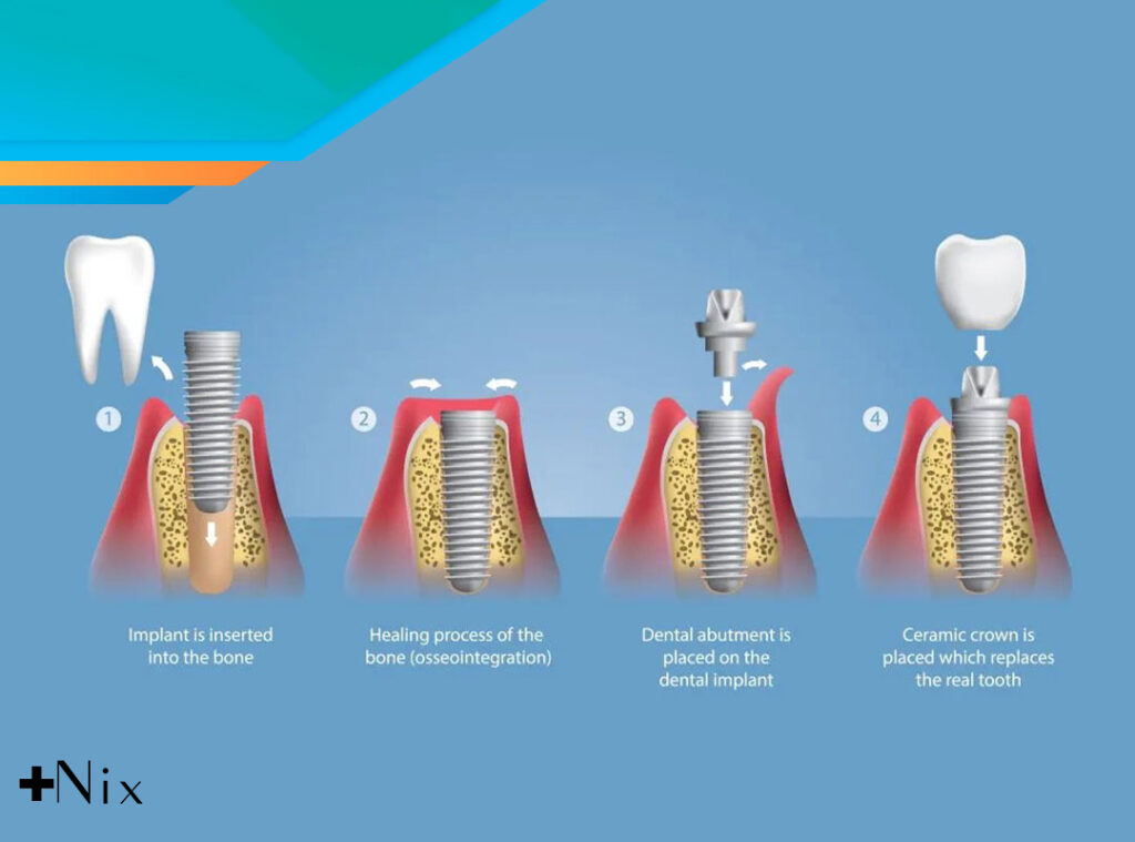 مراحل کاشت ایمپلنت