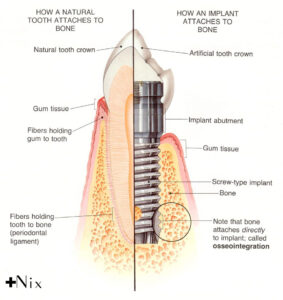 جراحی ایمپلنت دندان