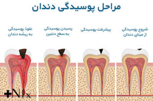 پیشگیری از دندان درد