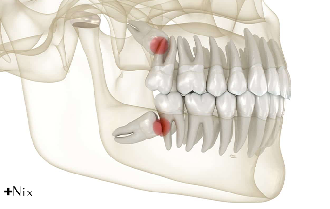 مشکلات دندان عقل